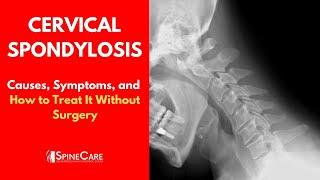 CERVICAL SPONDYLOSIS Causes, Symptoms and Treatment (NO SURGERY)