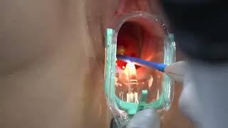 Cauterization of ulcer or ectoprion in the cervix