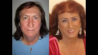 Amazing Facial Feminization Surgery Before and After pictures (Dr. Jeffrey Spiegel)
