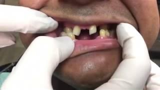 Houston Cosmetic Dentist ... underbite for Snap-on Smile ... and you can eat!!