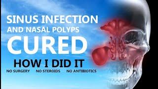 How I cured my chronic sinus infection and nasal polyps - without surgery, steroids or antibiotics