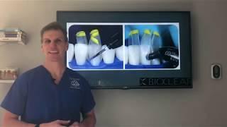 The best and easiest solution to closing tooth gaps: Bioclear! | Black triangles in teeth