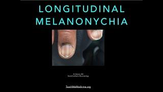 Nails: Longitudinal Melanonychia