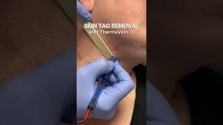 Eliminate skin tags effortlessly! #skintags #skintag #skintagremoval #europhoria #bakersfield