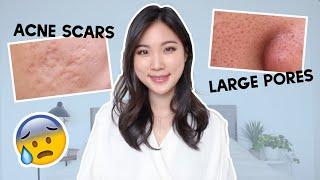  How to prevent acne scars, How to reduce large pores? Skincare Q&A