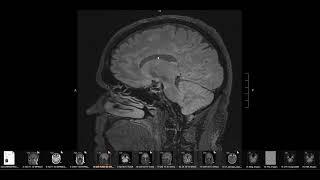 What does MS (multiple sclerosis) look like on brain MRI?  Avoid wrongful diagnosis!