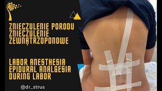 Znieczulenie porodu – znieczulenie zewnątrzoponowe // Labor anesthesia - Epidural analgesia