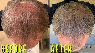 AMAZING BEFORE/AFTER MICRONEEDLING RESULTS FOR HAIR GROWTH!