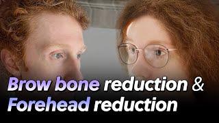 Brow bone reduction & Forehead reduction l Facial Feminization Surgery in Korea!