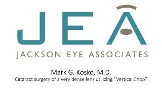 Kosko cataract surgery of a dense lens utilizing vertical chop