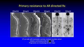 International Cancer Imaging Society Oct 17. Met - RADS - P, Anwar Padhani