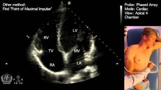Apical 4 Chamber View on Transthoracic Echocardiography (Cardiac Ultrasound)