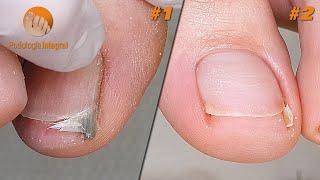 2 cases 1 video (V) | #1 Watch-glass nails | #2 Valgus flat foot and abrupt edge nails