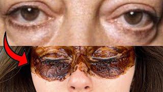 How to remove bags under eyes in 2 minutes! Why do I only know this now!