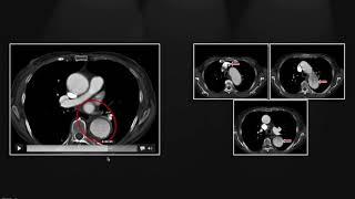 Aortic Dissection | Interesting Radiology Cases