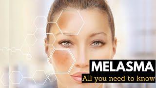 Melasma, Causes, Signs and Symptoms, Diagnosis and Treatment.