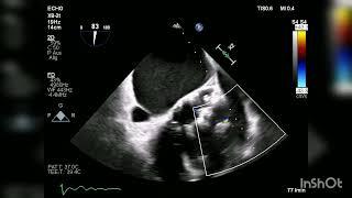 Pulmonary valve fibroelastoma