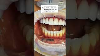 Dental Veneers composite veneers vs. porcelain veneers #dentalveneers #shorts #cosmeticdentistry