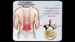 Lumbar Spine Transverse Process Fracture  - Everything You Need To Know - Dr. Nabil Ebraheim