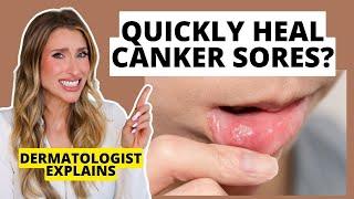 Quickly Heal Canker Sores: How to Prevent & Heal Them Faster | Dermatologist Explains