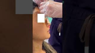 Nose Job Check | Rhinoplasty Before and After | Cast Reveal | Plastic Surgery | Cosmetic Procedure