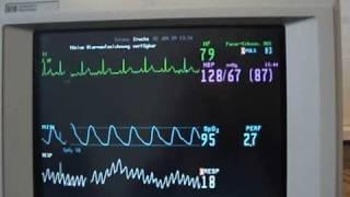 HP Viridia 24 ECG/Resp, SpO2 Alarms