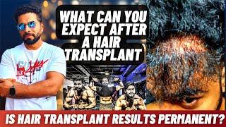 Is Hair Transplant Results permanent? | Ameer HT #ameerht