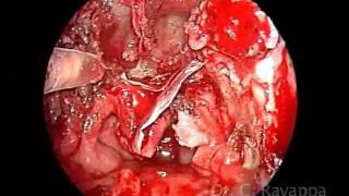 Nasopharyngeal malignant tumour, sarcoma,  endoscopic nasopharyngectomy by Dr. C. Rayappa