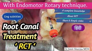 Root Canal Treatment step by step | on patient | RCT | रूट केनाल ट्रीटमेंट | Single visit RCT