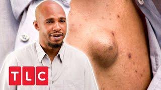 "Meine Kinder ekeln sich vor mir" | Dr. Pimple Popper | TLC Deutschland