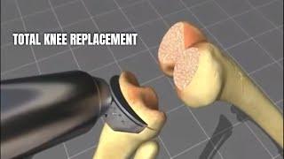 Total knee replacement surgery (TKR ) |Medical Animation