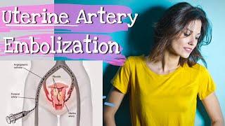 Live Uterine Artery Embolization Procedure video for Adenomyosis and Fibroids in Hyderabad