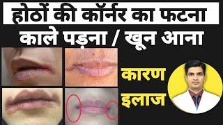 होठों के कार्नर का कालापन पड़ना | Angular cheilitis