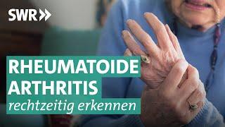 Rheumatoide Arthritis: Diagnose häufig zu spät | Doc Fischer SWR