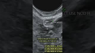 #Endometriosis may be small sometimes, but that doesn’t mean it can’t be found on ultrasound!