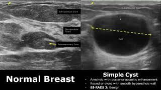 Small Parts Ultrasound Normal Vs Abnormal Images | Thyroid, Breast, Scrotum, Testis, Eye USG