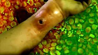 Deep Pus Filled Hole In My Cousin's Arm! Very Deep Abscess! (WARNING: Graphic!)