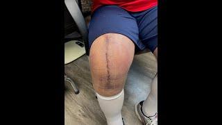 9 Days from Outpatient Knee Replacement (MAKO) Doing Great | Robert Cagle, MD