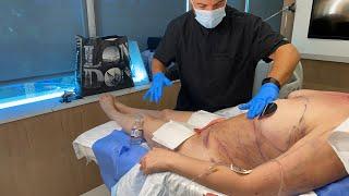 INSTANT HD LIPO RESULTS FOLLOWED BY LYMPHATIC MASSAGE West Hollywood, CA | Dr. Jason Emer