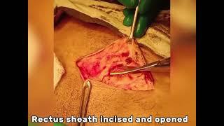 prostate ( Transvesical prostatectomy)