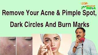 Remove your acne pimple spot, dark circles and burn marks : Rajiv Dixit