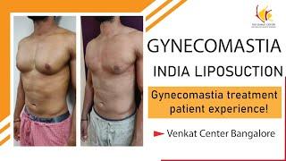 Gynecomastia treatment- a patient experience! Venkat Center Bangalore. India liposuction