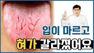 입마름이 심해지더니 혓바닥이 갈라지고 아파요