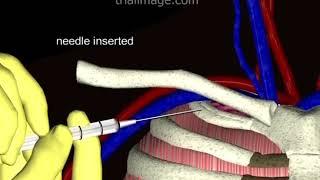 Subclavian Vein Access - Normovolemic Patient Animation by Cal Shipley, M.D.