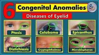 6 Common Anomalies of Eyelid (Video-2)