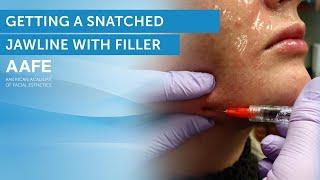 Jawline Filler With Cannula Technique