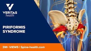 Piriformis Syndrome