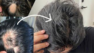 2 Year Alopecia Hair Growth Update | hair growth tips & products