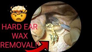 HARD EARWAX REMOVAL!!