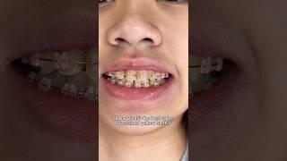 Best Braces Colors for Stained Yellow teeth